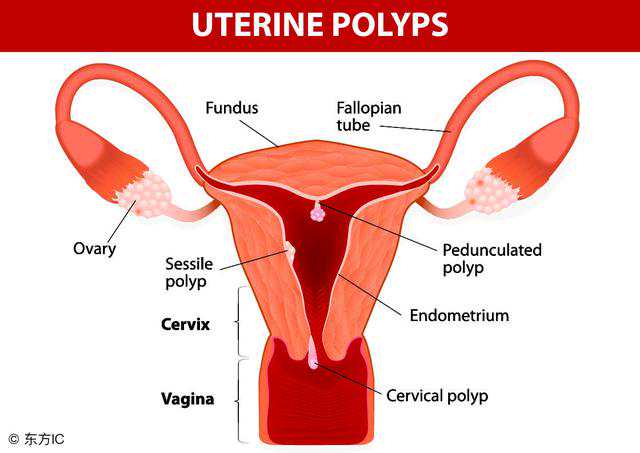 做供卵女方要注意什么&代孕包成功&宫颈息肉易致不孕，宫颈息肉要做哪些检查